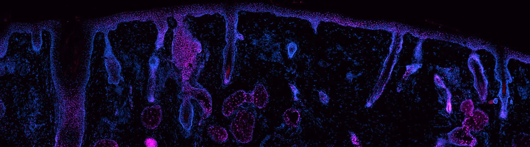 Methylome profiling for melanoma detection